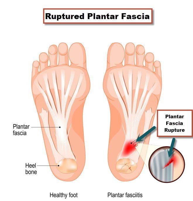 Normal Plantar Fascia compared to a ruptured Plantar Fascia from the Jacksonville Orthopaedic Institute