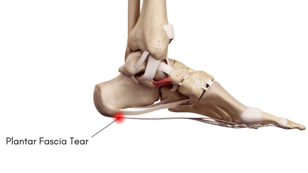 Plantar Fascia Tear diagram from James McCormack