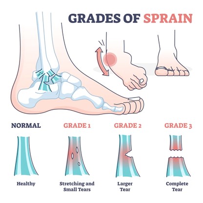 Grades of Ankle Sprain from Rothman Orthopaedics