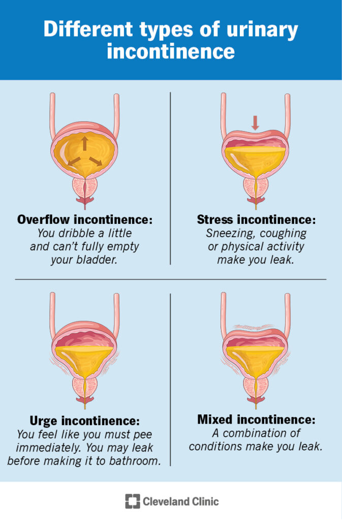 Types of Urinary Incontinence from Cleveland Clinic