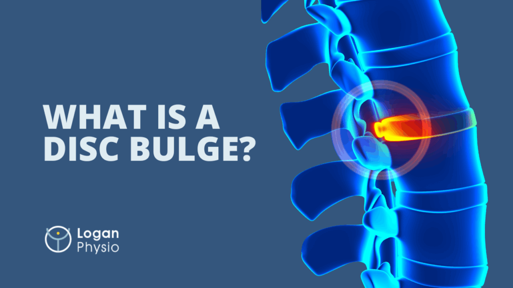 Disc Bulge Recovery: Proven Strategies to Relieve Pain and Regain Strength Naturally