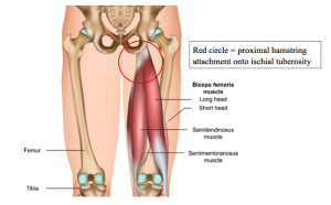 Hamstring Insertion Pain Proximal Hamstring Tendinopathy: Causes, Symptoms, And Effective ...